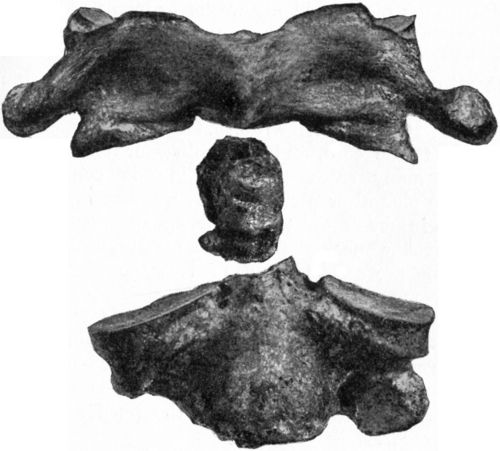 Fig. 209.—Fracture of Odontoid Process of Axis Vertebra.