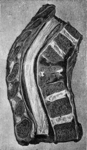 Fig. 210.—Tuberculous Osteomyelitis affecting several vertebræ at Thoracico-lumbar Junction.