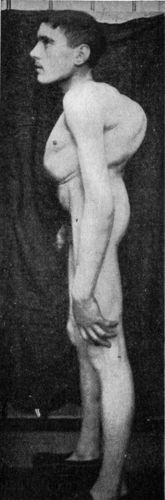 Fig. 216.—Hunch-back Deformity following Pott's disease of Thoracic Vertebræ.