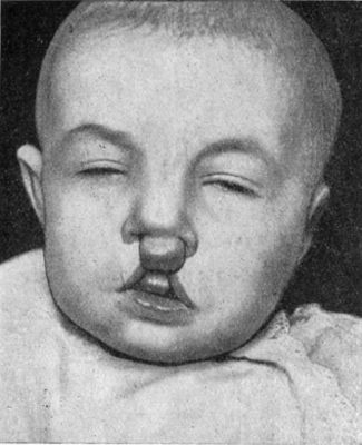 Fig. 235.—Double Hare-lip with Projection of Os Incisivum, in an infant before first dentition.