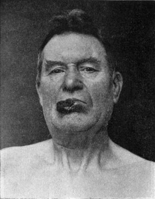 Fig. 242.—Squamous Epithelioma of Lower Lip in a man æt. 55.