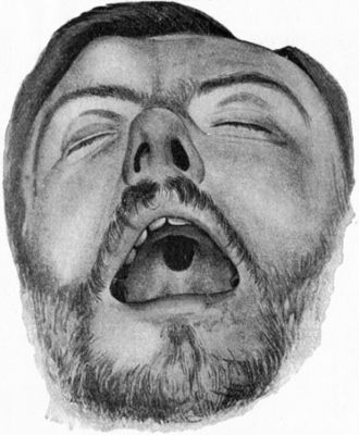 Fig. 246.—Perforation of Palate, the result of Syphilis, and Gumma of Right Frontal Bone.