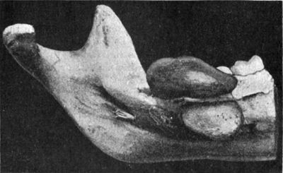 Fig. 249.—Epulis of Mandible.