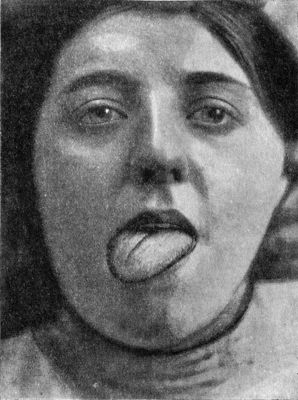 Fig. 260.—Temporary Unilateral Paralysis of Tongue, from bruising of hypoglossal nerve during operation for tuberculous cervical glands.