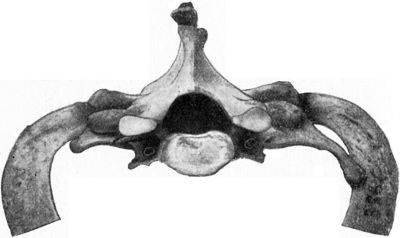 Fig. 269.—Bilateral Cervical Ribs; the left one is the better developed.