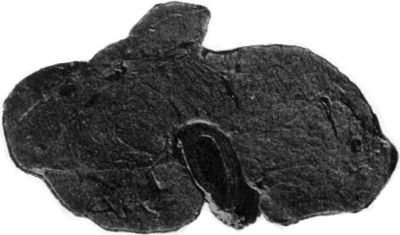 Fig. 279.—Section of Goitre shown in Fig. 278, to illustrate compression of Trachea.