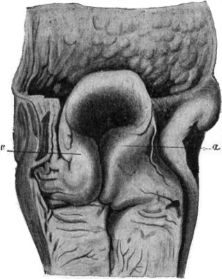 Fig. 287.—Larynx from case of sudden death, due to œdema of ary-epiglottic folds, a, a.