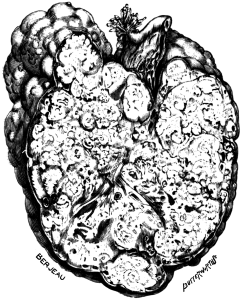 Secondary Cancer of the Ovary