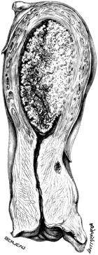 Villous Disease of the Uterus