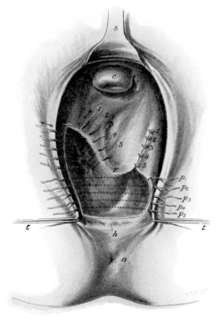 Laceration of the Pelvic Floor