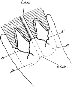 Marckwald’s Operation for Congenital Hypertrophy of the Cervix