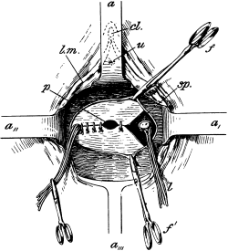 Vaginal Hysterectomy