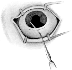 Cataract Extraction