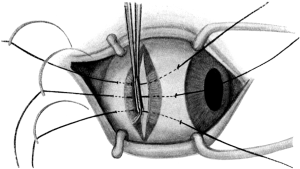 Advancement by the Three-stitch Method