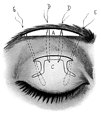 Ptosis Operation. Panas’