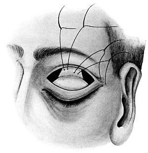 Ptosis Operation