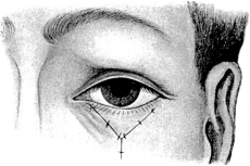 VY Operation for Ectropion