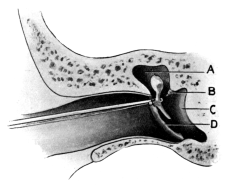 Removal of the Malleus by Wilde’s Snare