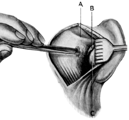 Schwartze’s Operation