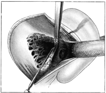 The ‘Radical’ Mastoid Operation