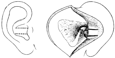 Körner’s Post-meatal Flap