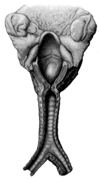 Stenosis following Tracheotomy