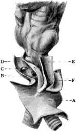 Trachea showing Ulceration into the Innominate Artery after Tracheotomy