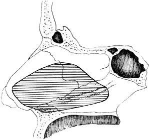 Submucous Resection of the Septum.