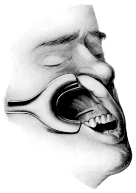 The Incision in the Caldwell-Luc Operation upon the Maxillary Sinus