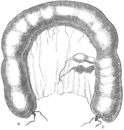 Natural relations of the   diverticulum to the intestine