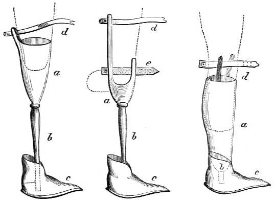 Shows amputation above knee with prosthetic and   two styles of amputation below the knee with prosthetic.