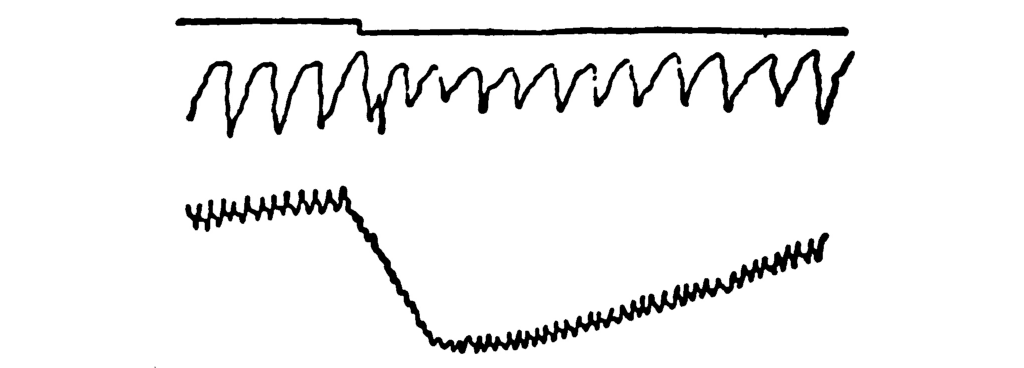 Another polygraph record.         In this one the rhythm in the waves of the middle line are         disrupted at the one-third point, and do not entirely return         to normal. Likewise, the dip in the bottom line is deeper yet,         and only just climbs back to its original height.