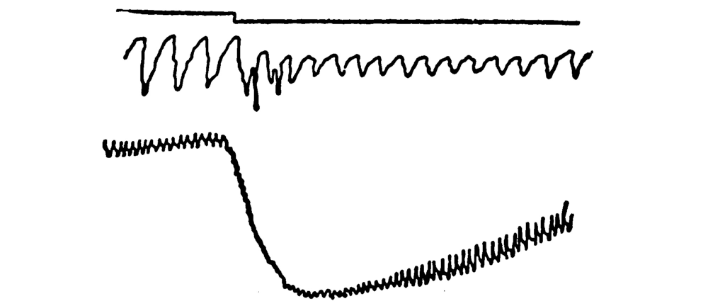 Another polygraph record.         The waves of the middle line contract severely at the         one-third point, and remain contracted. Likewise, the bottom         line dips precipitously, and only returns to half of its         original height.