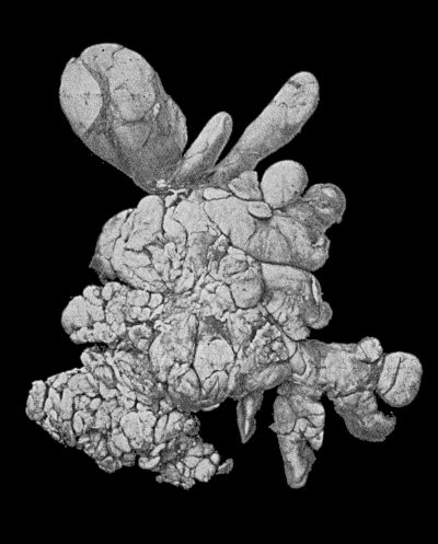 Fig. 45.—Subcutaneous Lipoma showing lobulation.