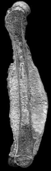 Fig. 146.—Periosteal Sarcoma of Femur in a young subject.