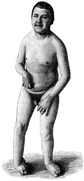 Fig. 20. Idiotismus mit zebraler Kinderlhmung.