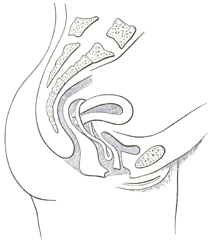 Pelvic organs sustained by Emmet pessary