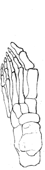 Misaligned foot bones